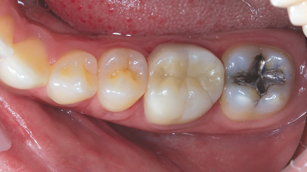 BruxZir® Full-Strength Solid Zirconia used on teeth (top view)