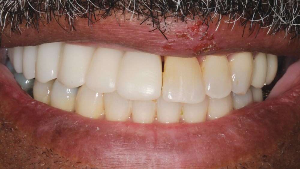 Figures 13a, 13b: Because of the excessive vertical bone loss created by the periodontally involved teeth, it was determined that the final BruxZir Solid Zirconia prosthesis would be designed and milled with gingival areas and pink coloring to maximize esthetics. A gingival shade guide was used to select the proper shade for the soft-tissue portion of the prosthesis.