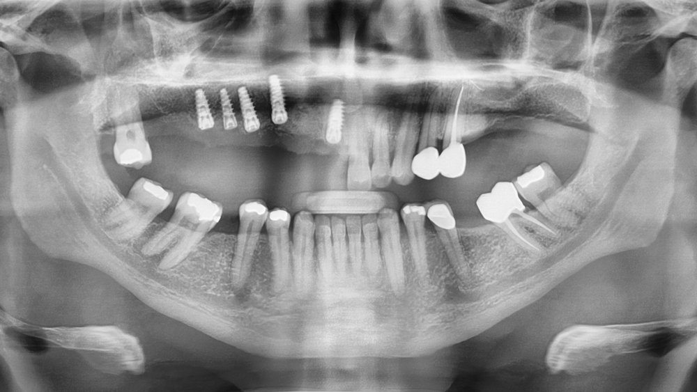 Figure 9: Postoperative panoramic radiograph illustrates the positioning of the Hahn Tapered Implants in the maxillary right quadrant.