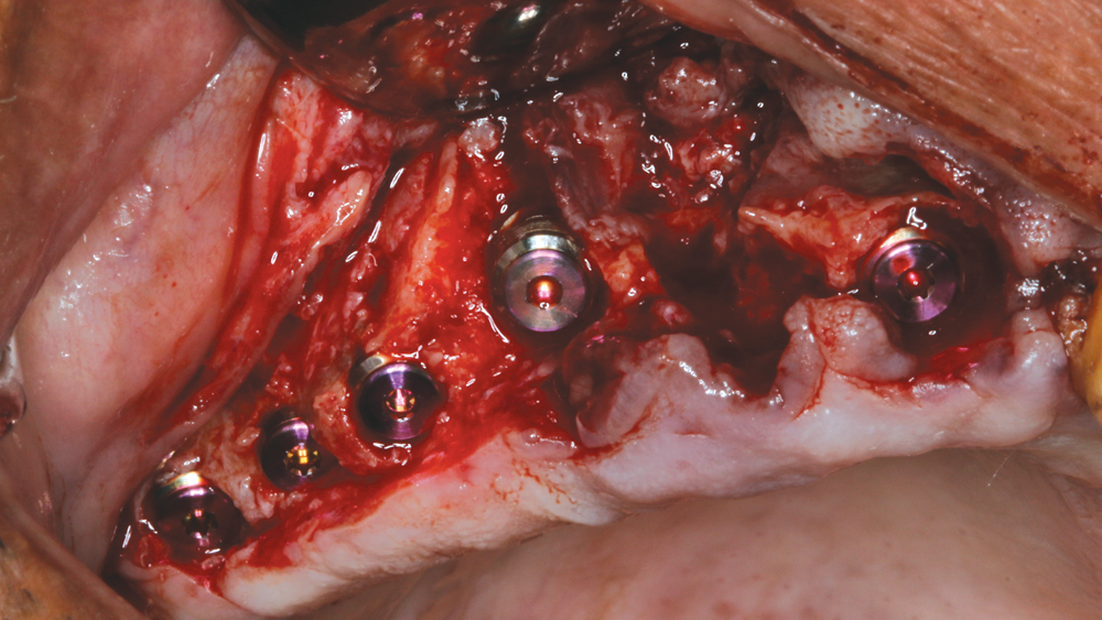 Figure 5: Five Hahn Tapered Implants were immediately placed into the socket sites using the Hahn surgical protocol.