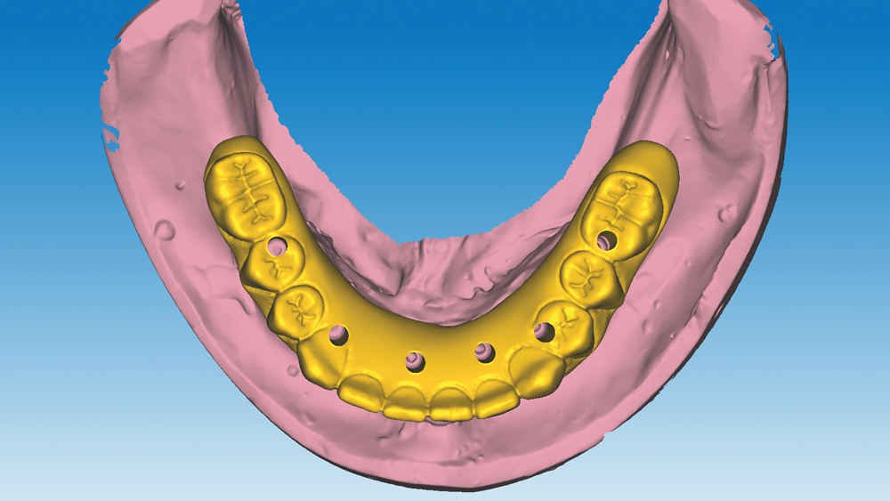 digital design for the monolithic zirconia implant restoration using advanced CAD/CAM software