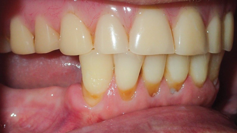 : Lateral views illustrate ridge resorption and thin soft tissue in the posterior areas of the mandible
