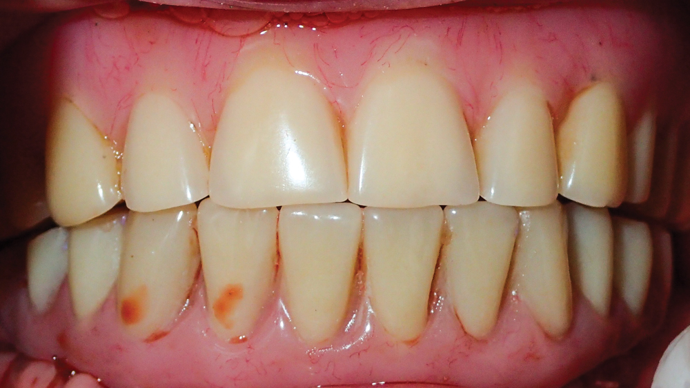 occlusion of the provisional implant prosthesis gets verified against the patient’s existing upper denture