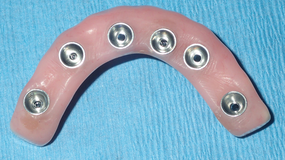  immediate denture was modified to serve as a fixed provisional prosthesis by adding and trimming temporary cylinders