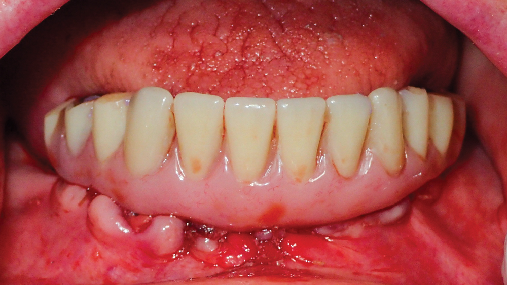 converted denture is connected to the implants