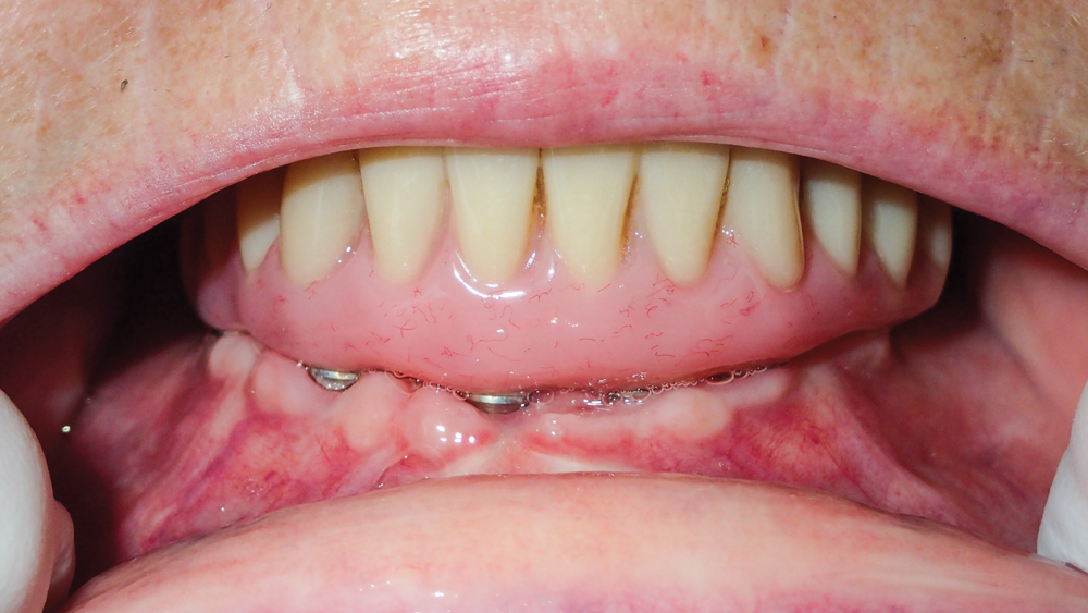 patient's mouth after five months of healing