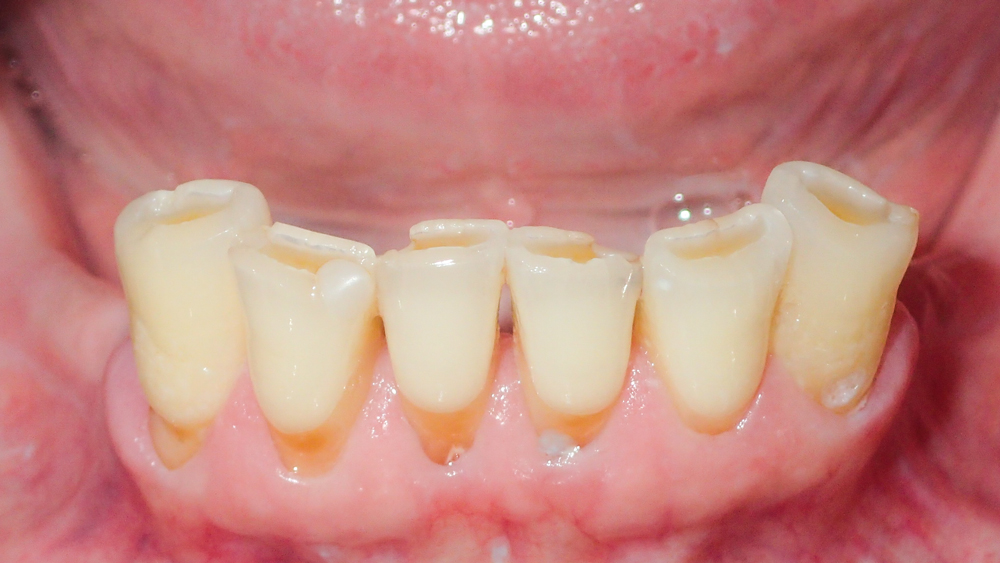  patient’s remaining lower teeth were painful and exhibited periodontal involvement and loss of attached tissue
