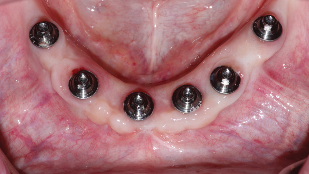 patient is prescribed a BruxZir Full-Arch Implant Prosthesis