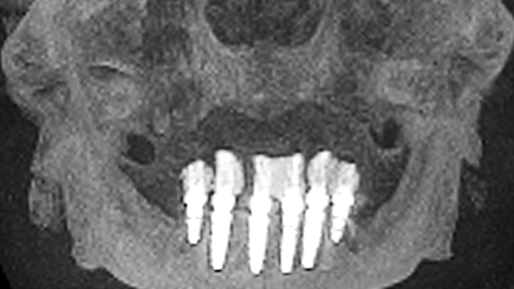 Postoperative CBCT scans illustrate the six axially placed Hahn Tapered Implants