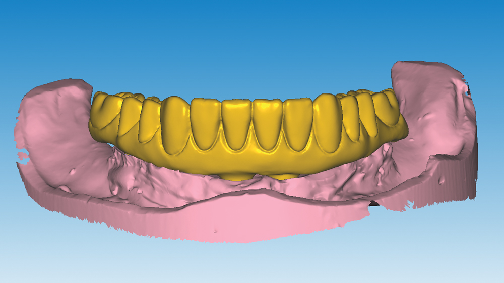 digital design for the monolithic zirconia implant restoration using advanced CAD/CAM software