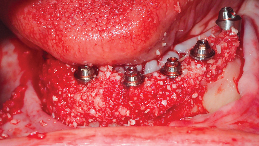 Inclusive Multi-Unit abutments were connected to the implants