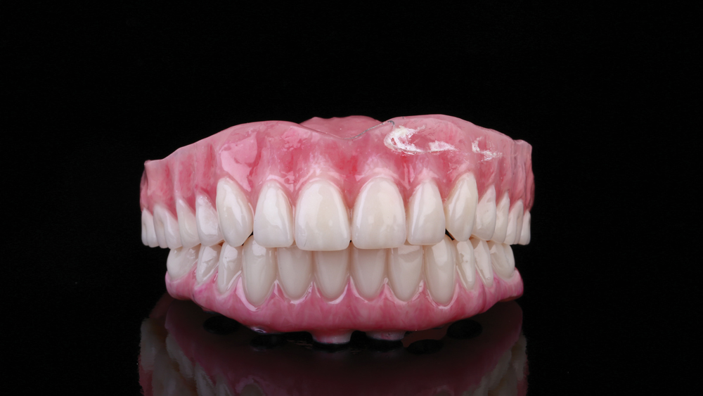 Advanced staining techniques were used to achieve consistent, lifelike gingival and tooth shades for the denture and implant prosthesis