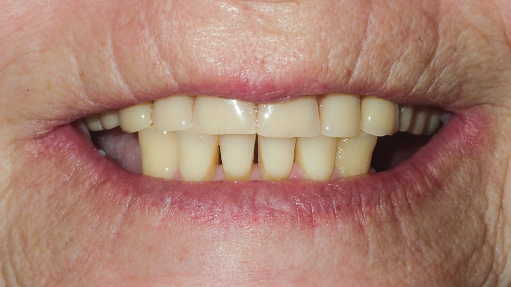 heavily worn upper denture and lower partial denture
