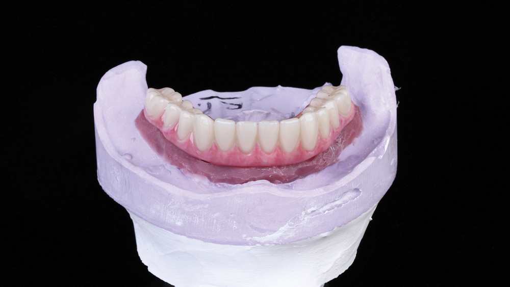 lab fabricated a PMMA provisional implant prosthesis
