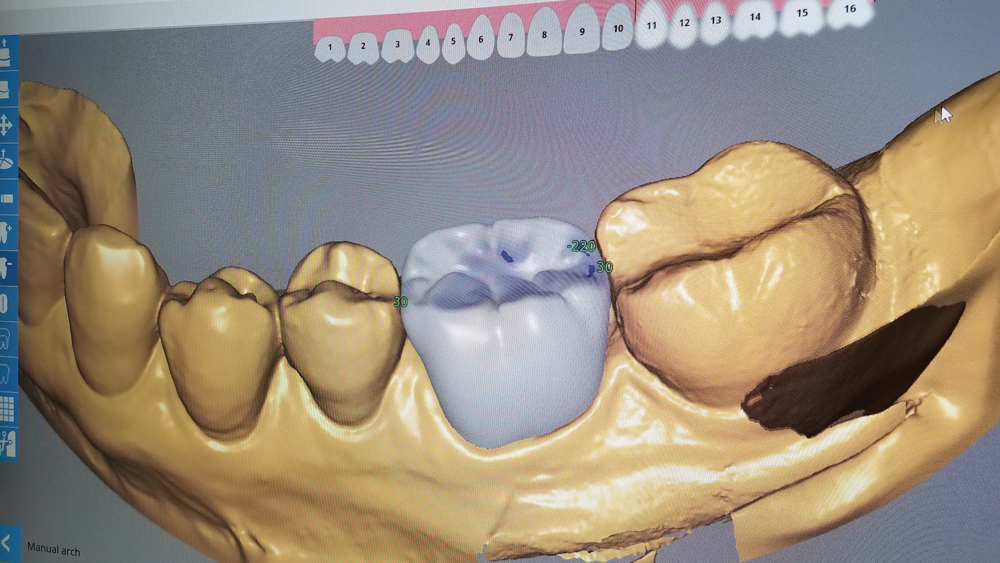 Occlusal and buccal views of crown proposal generated by the fastdesign.io Software