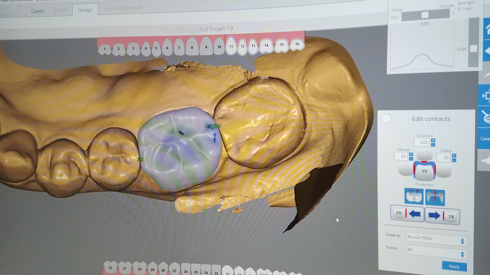 Occlusal and buccal views of crown proposal generated by the fastdesign.io Software