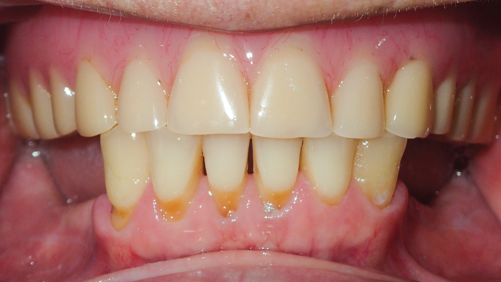 Old amalgam was removed exposing tooth structure