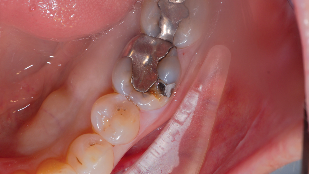 Figure 1a: Initial condition of patient with cusp fracture and missing portion of amalgam
