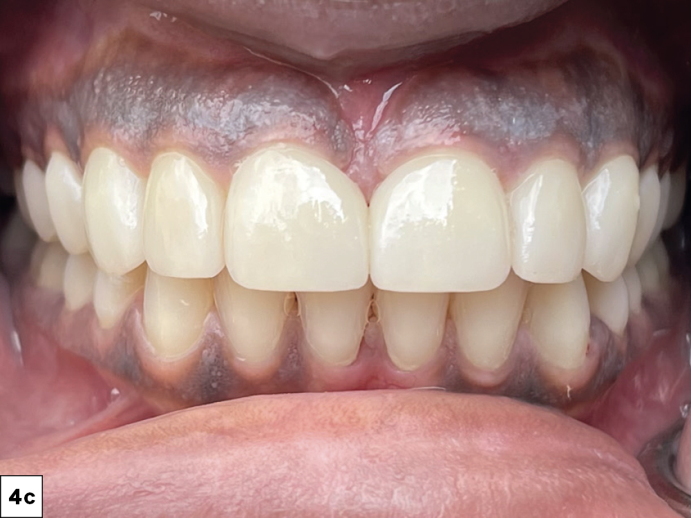 Figure 4c after procedure with IPS e.max® and veneers used