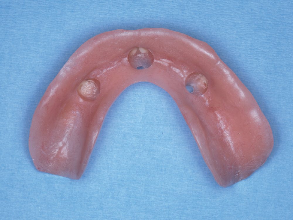 Wells for the Locator abutments and attachments were created by the lab and then verified for passivity chairside