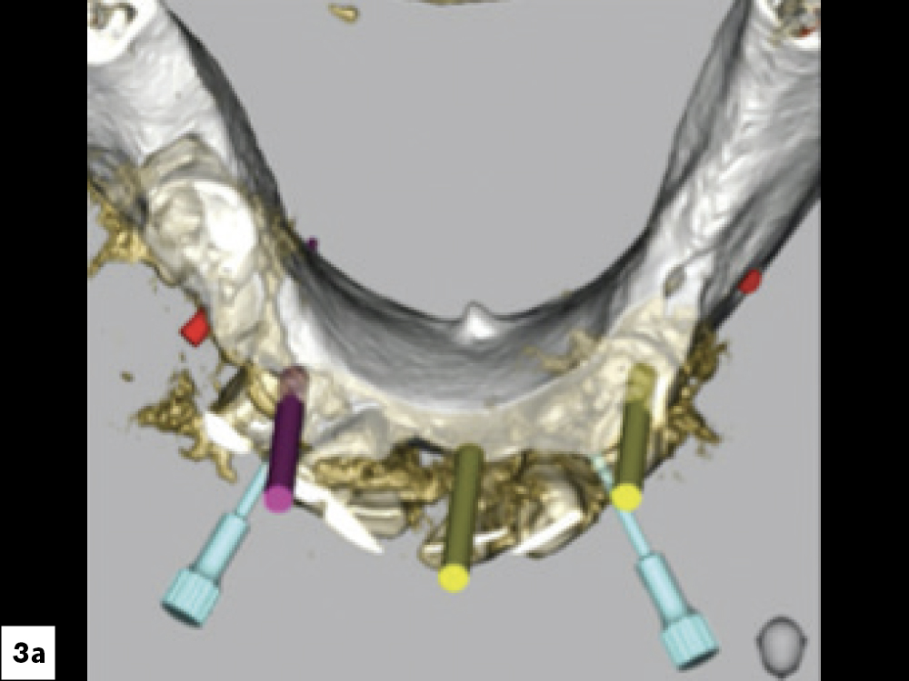Place three implants in the mandible to help retain the denture