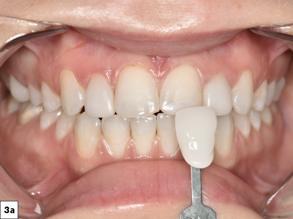 Figure 3a - Teeth before being prepped