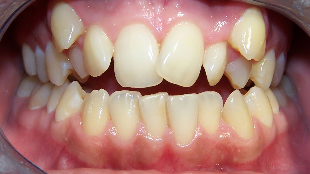 cm0203-6-month-orthodontics-10