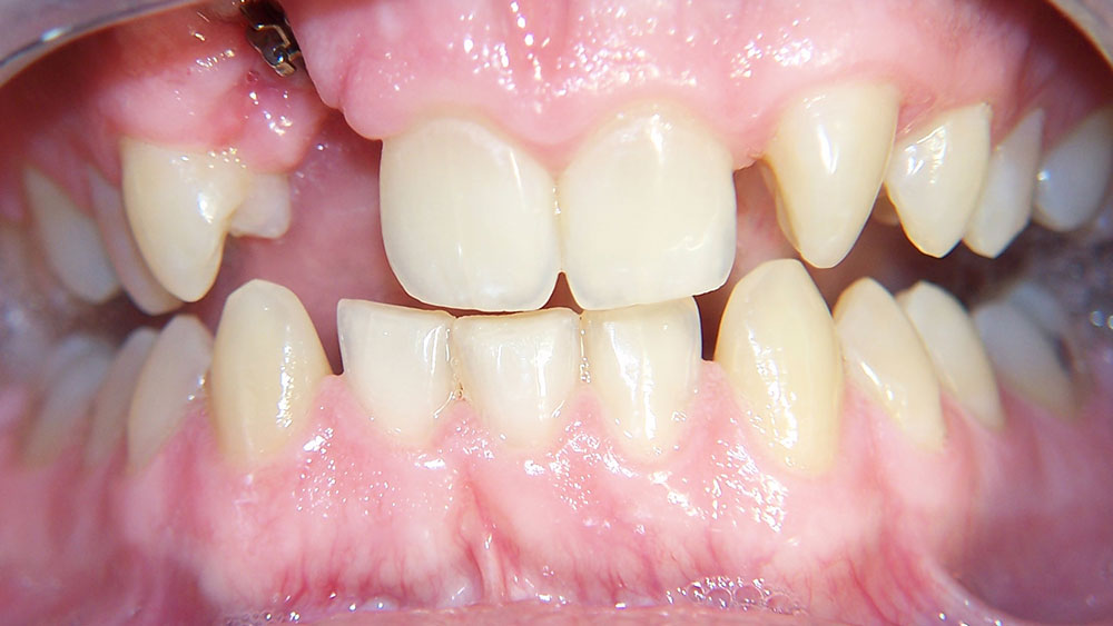 cm0203-6-month-orthodontics-08