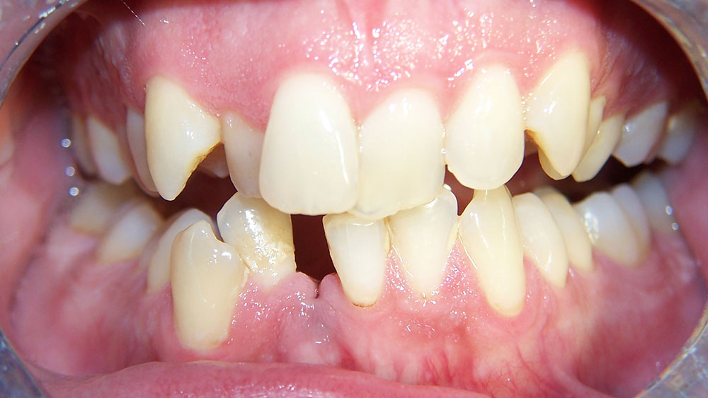 cm0203-6-month-orthodontics-14