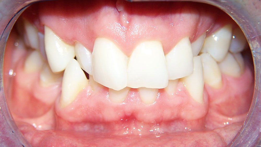 cm0203-6-month-orthodontics-12