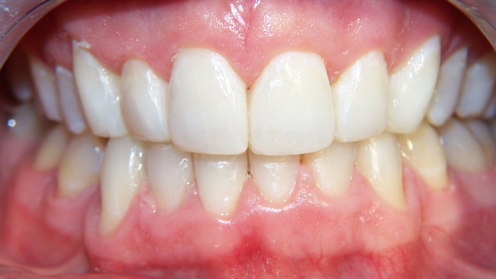 cm0203-6-month-orthodontics-13