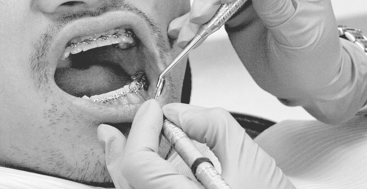 Six-Month Adult Aesthetic Orthodontic Treatment