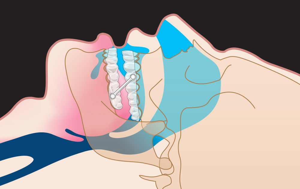 Oral appliance solution image