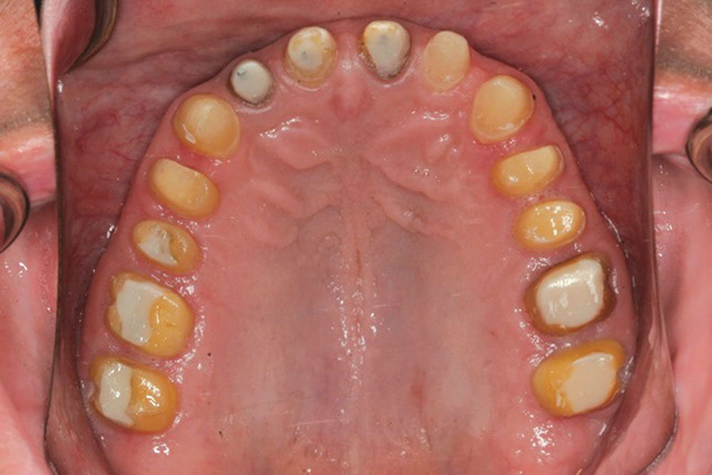 Figure 10: The day of the reline appointment after four weeks of healing. The provisionals will be closed to fit the teeth, leaving 1 mm of space between the provisional and the tooth surface to allow for future biologic width growth in a coronal direction. No prepping of the tooth surface is done at this appointment.