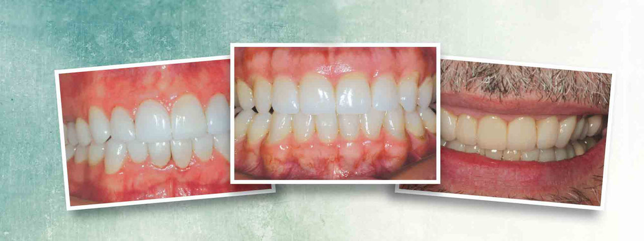 Prosthetic Tooth Repositioning Main Image
