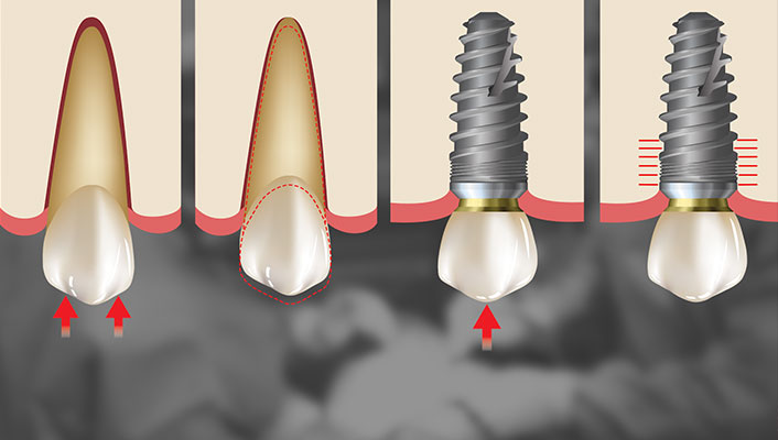 Principles of Implant Occlusion: Part 1 Online Course