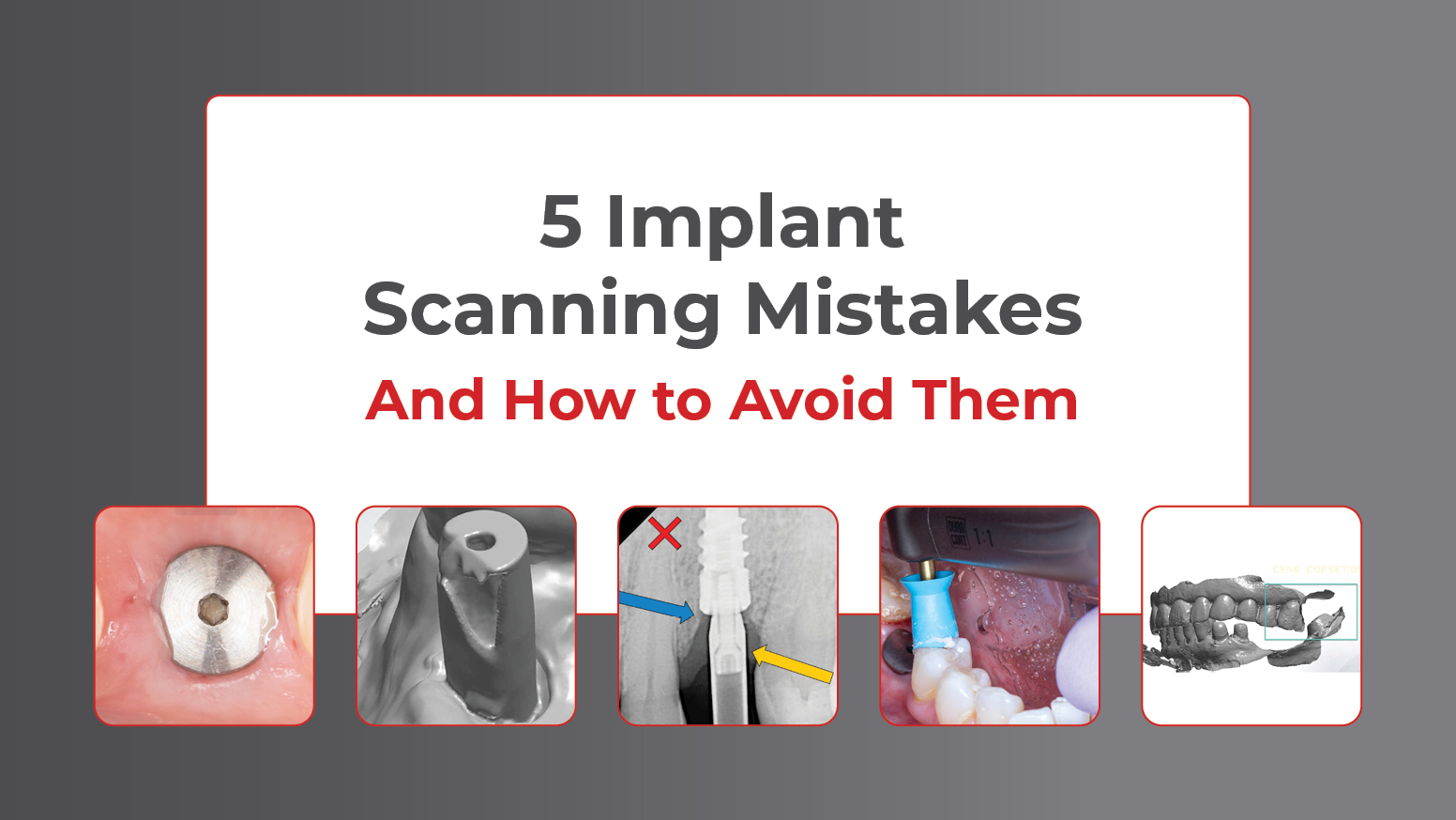 5 Intraoral Scanning Mistakes that Lead to Implant Remakes (And How to Prevent Them)