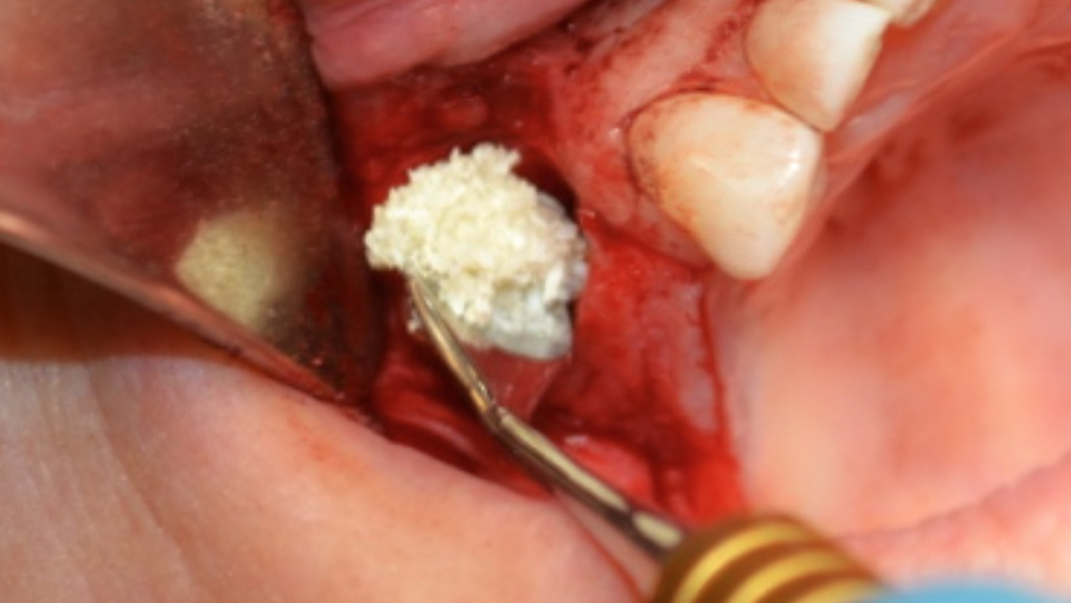 Common Dental Bone Graft Procedures: Materials &amp; Tools | Glidewell