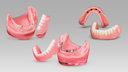 3 Types of Implant Overdentures: Which Patients Are the Best Candidates? image