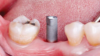 Better Scans, Better Restorations: Implant Scanning Made Simple image