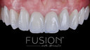 Fusion with BruxZir™ Zirconia: Restorations that Mimic Nature Perfectly  image