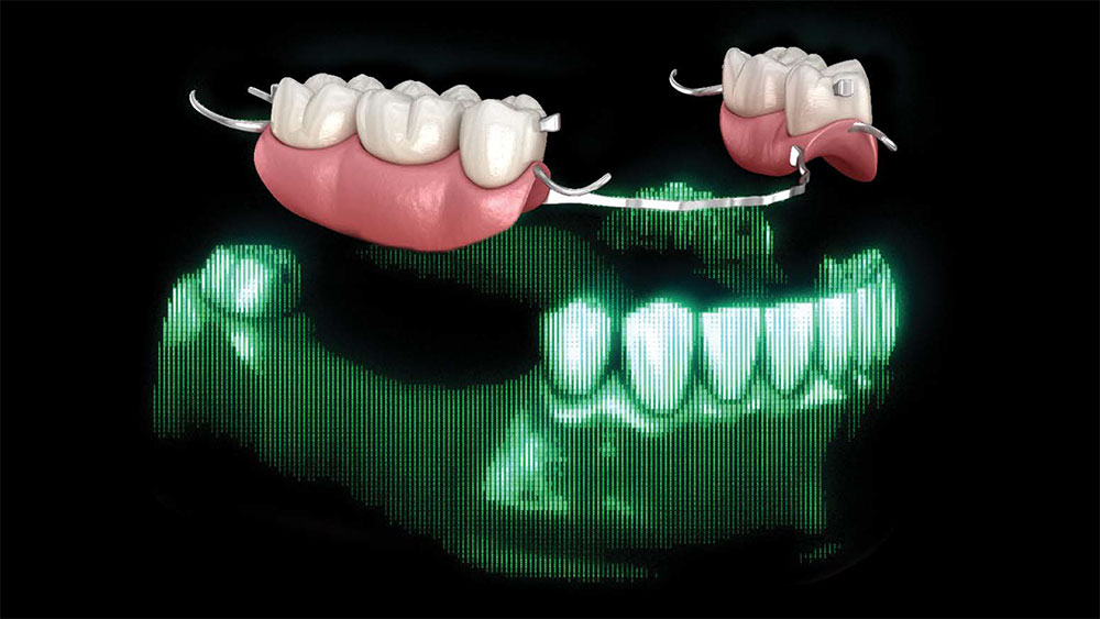 How to Make a Crown Beneath an Existing Partial Denture
