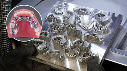 Revolutionizing Removables: SLM-Printed Metal Partial Dentures image
