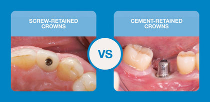 Screw-Retained vs. Cement-Retained Implant Crowns: How to Choose the Right Restoration image