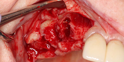Hahn Tapered Implants are used to treat an edentulous span in the maxillary arch. thumbnail image