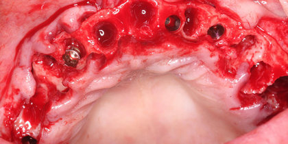 After extracting a patient’s non-restorable maxillary dentition, Hahn Tapered Implants are inserted to retain an implant overdenture. thumbnail image