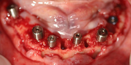 The terminal dentition of a mandibular arch is restored with seven Hahn Tapered Implants and a full-arch monolithic zirconia prosthesis. thumbnail image