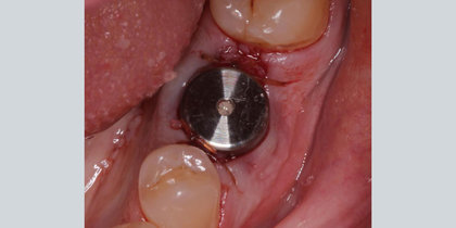 A Hahn Tapered Implant is immediately placed following the extraction of tooth #19. thumbnail image