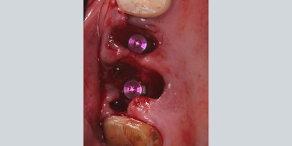 Hahn Tapered Implants are immediately placed into extraction sites in the areas of tooth #3 & #4. thumbnail image