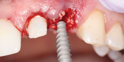 Tooth #10 is immediately replaced with a Hahn Tapered Implant, leading to an esthetic final restoration. thumbnail image